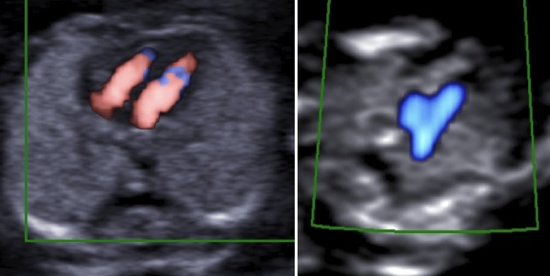 A basic heart exam in the first trimester using colour Doppler and/or...