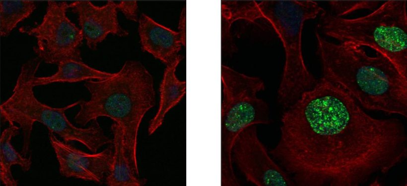 Human lung cancer cells under the microscope, before (left) and after (right)...