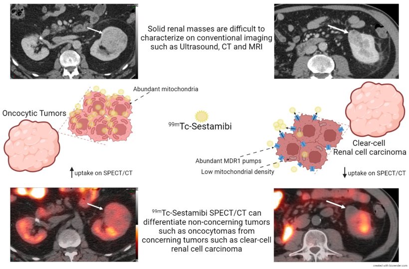 Diagnostic accuracy of 99mTc-Sestamibi SPECT/CT for characterization of solid...