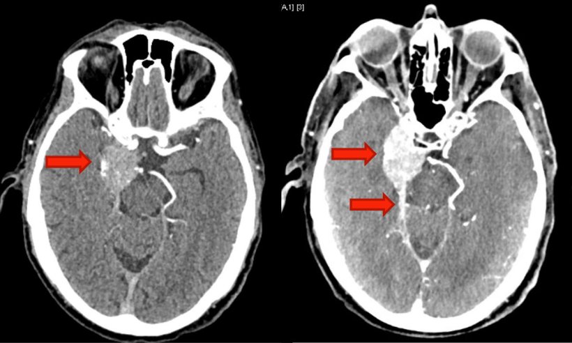 Head CT scan of a patient with a meningioma who was scanned on a conventional...