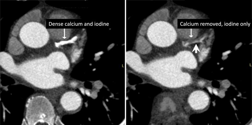 Cardiac CT images of a patient with dense calcification in his left anterior...