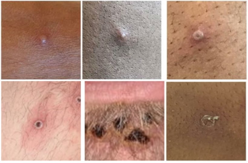 Visual examples of the monkeypox rash  (left to right, top to bottom): early...