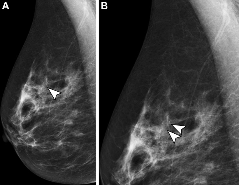 Mammograms in a 54-year-old woman undergoing her second screening mammographic...