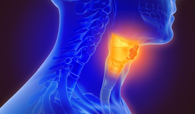 3d illustration of throat cancer