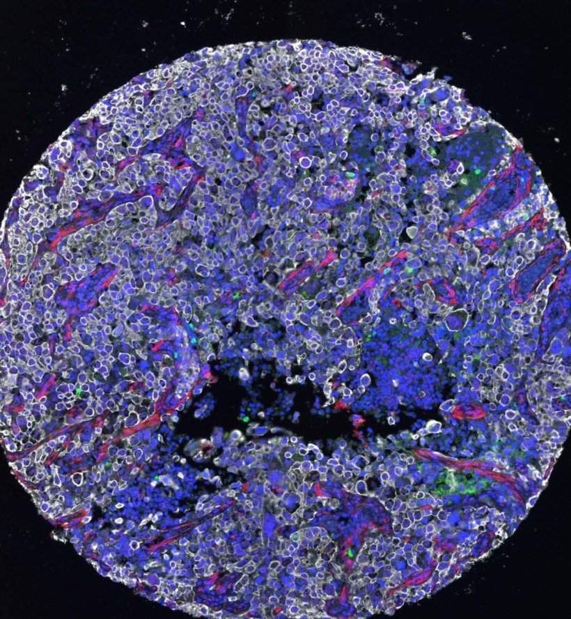 Microscopy of a lung tumor biopsy.