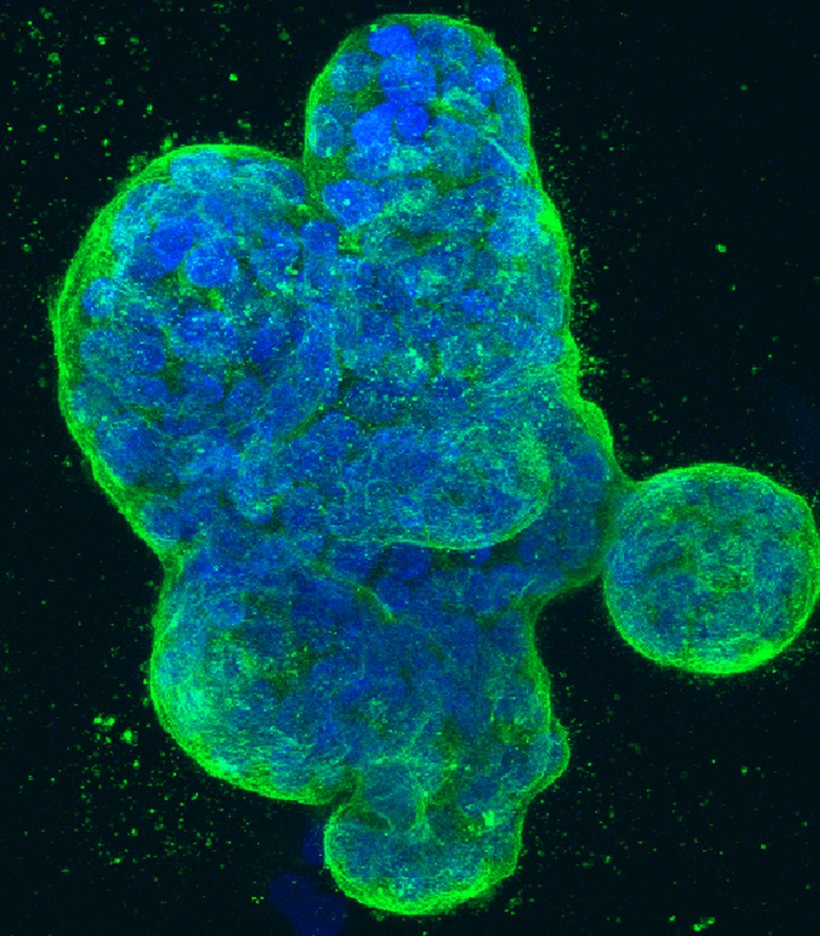 Dreidimensionale Kultur menschlicher Brustkrebszellen, mit blau gefärbter DNA...