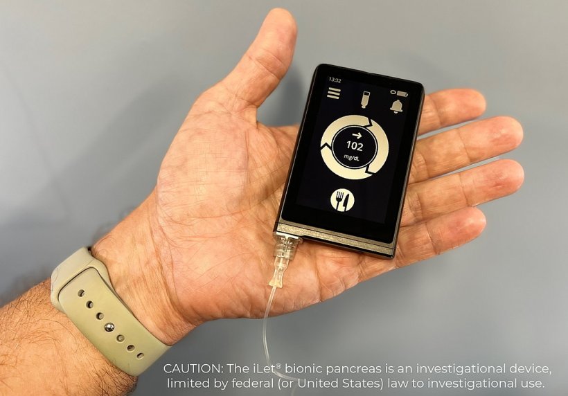 Type 1 diabetes researchers explore benefits of 'bionic pancreas