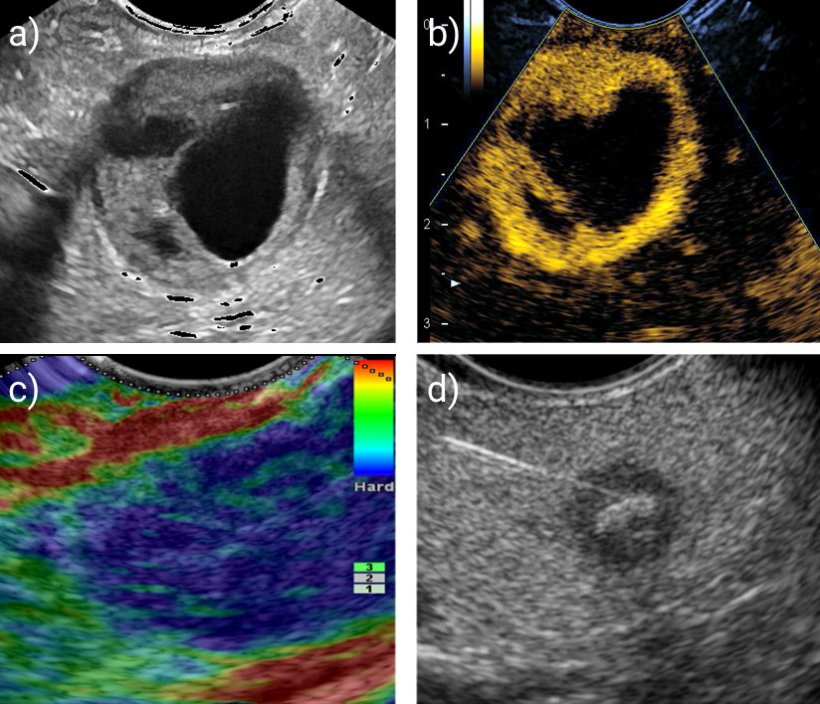 Endoscopic Ultrasound (EUS) is considered a supreme discipline in imaging,...