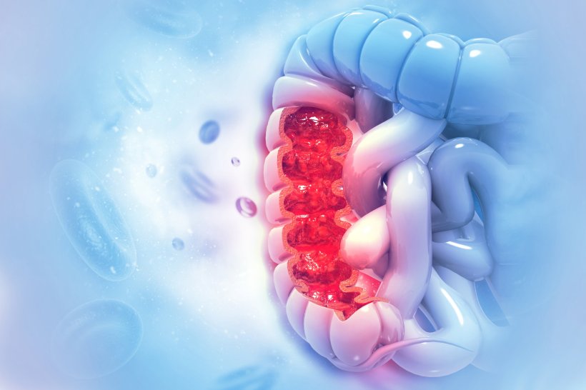 Colon cancer concept illustration