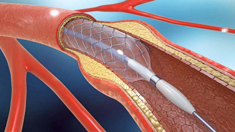 3d illustration of stent implantation for supporting blood circulation into...