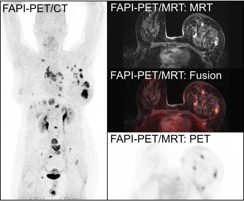 Patientin mit Brustkrebs. Ein FAPI-PET/CT (links) und anschließendes FAPI...
