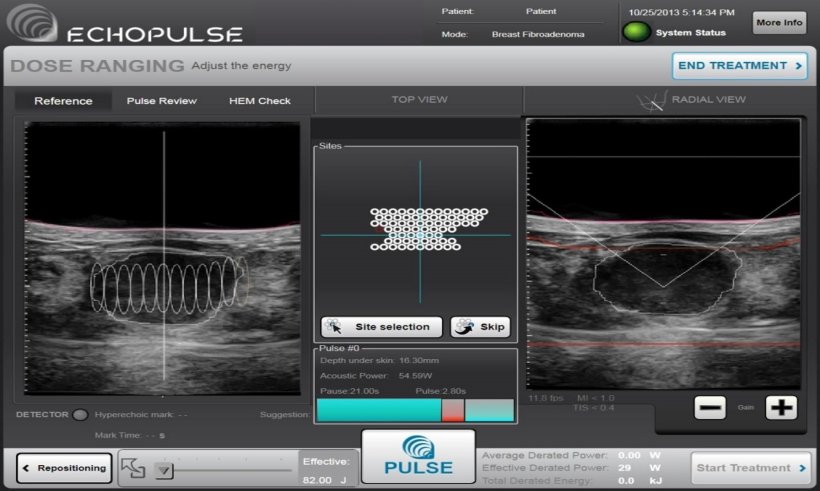 HIFU treatment plan, showing (right) fibroadenoma as viewed in the cross...