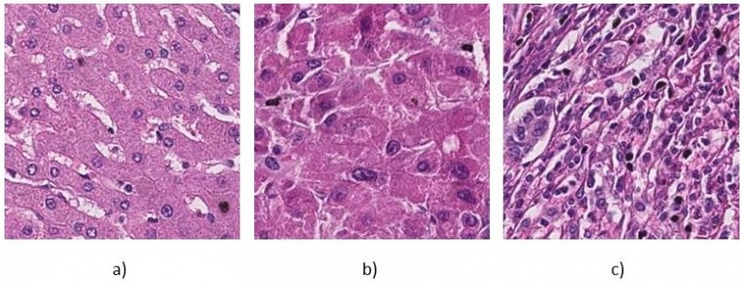 a) H&E stained liver tissue of healthy patient, b) Grade 1 (well...