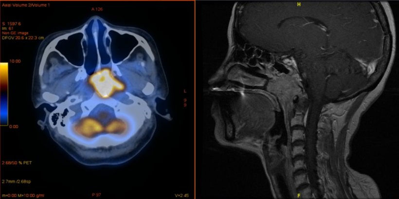 Nasopharyngeal tumors (highlighted in yellow) - are a common condition in...