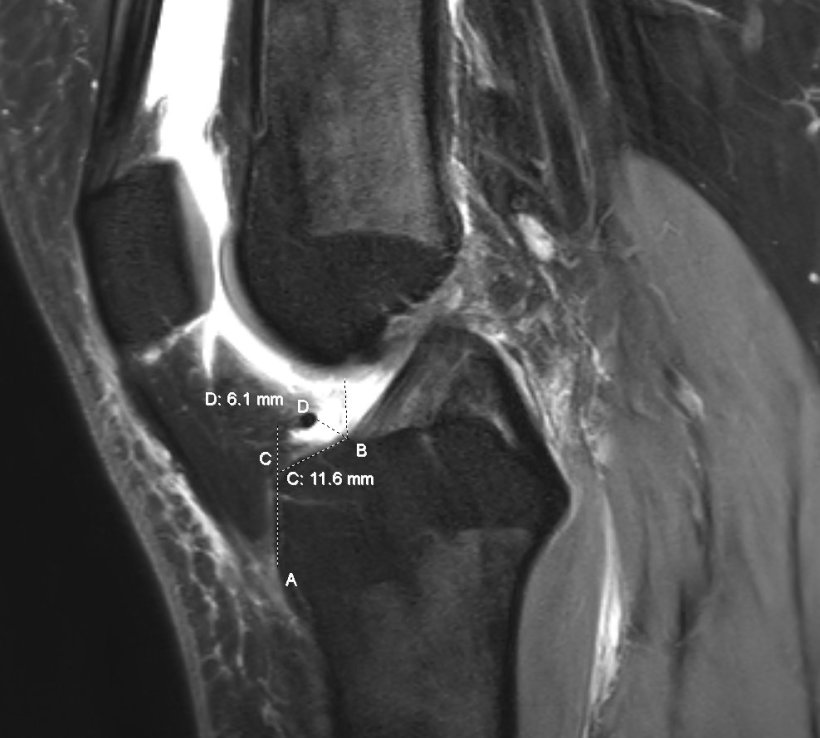 A magnetic resonance image (MRI) of the knee illustrates how the anterior...