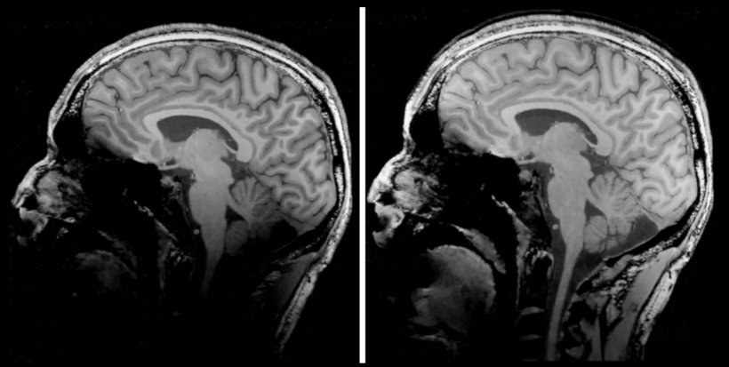 Conventional 7T acquisition with clear signal loss in the lower part of the...