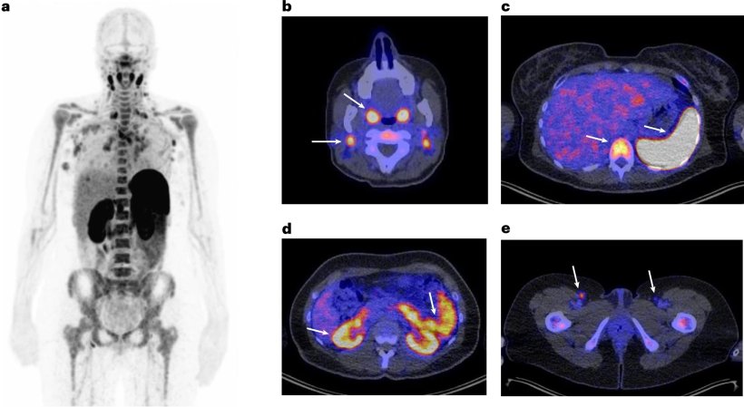 Whole body scan shows complexity of immunotherapy response