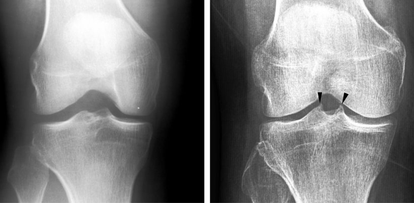 Two knee radiographs rated for spiking of tibial tubercles are compared. The...