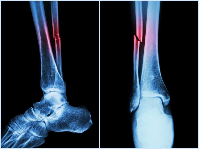 Bone fracture in the fibula (symbolic image)