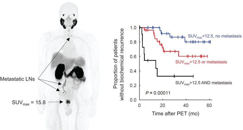 Graphical Abstract: Left: Maximum intensity projection of 68Ga-PSMA PET in a...