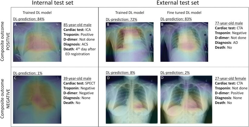Gradient-weighted class activation maps of representative chest radiographs in...