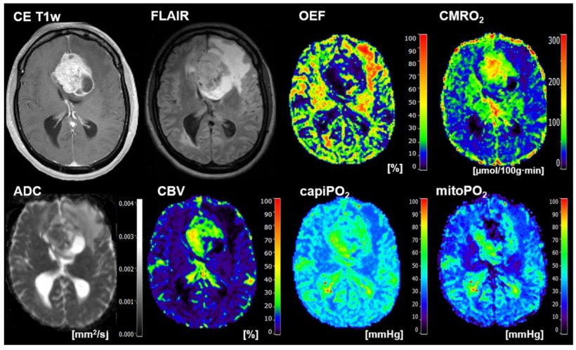 Representative case of a 47-year-old female patient suffering from a brain...