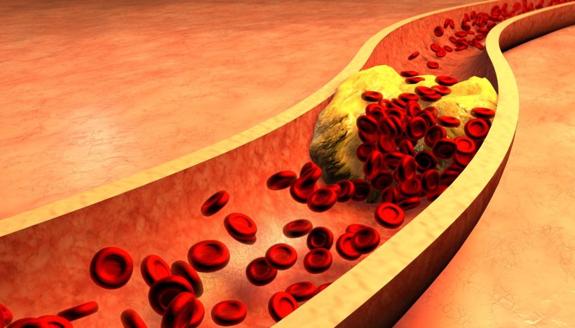 3d animation of clogged artery