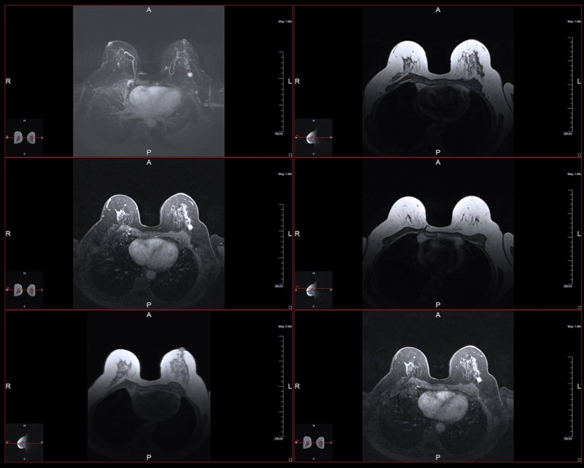 Breast MRI scans