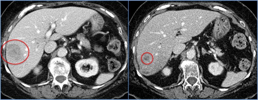 Left: 82-year-old woman with solitary 4.5 cm metastatic breast cancer in the...