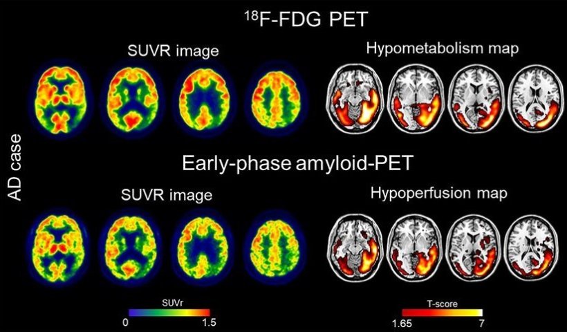 This graphical Abstract shows the comparability of early-phase amyloid-PET and...