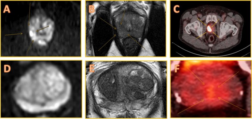 Annotation of suspicious lesions on imaging. A–C Concordant positive findings...