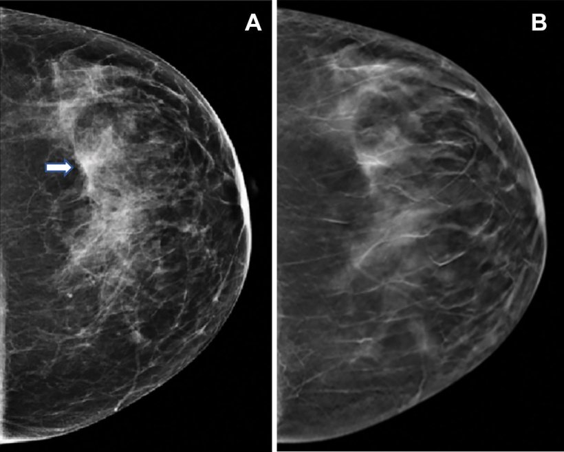 Images in a 47-year-old woman who presented for routine screening. (A)...