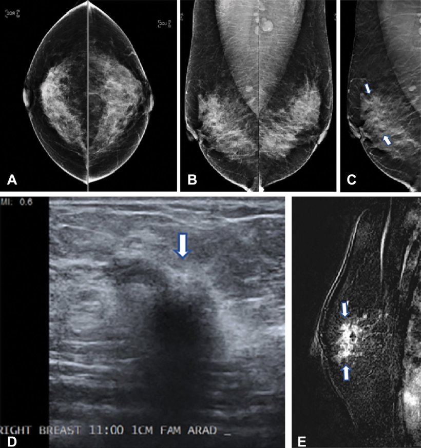 Images in a 42-year-old woman who presented for routine screening. (A)...