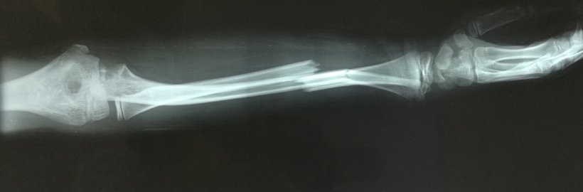 xray of arm with fractured bones