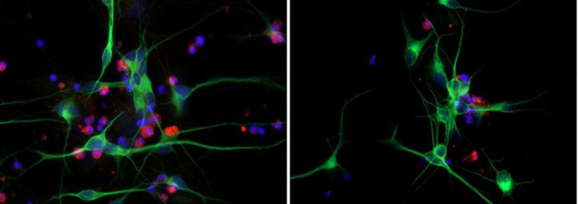 Menschliche Neuronen aus von ALS-Patienten stammenden iPS-Zellen: Neuronen (in...