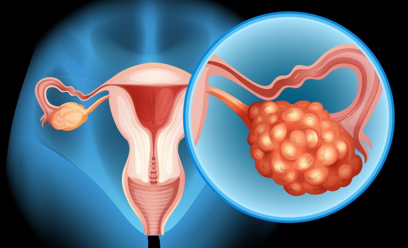 illustation of ovarian cancer