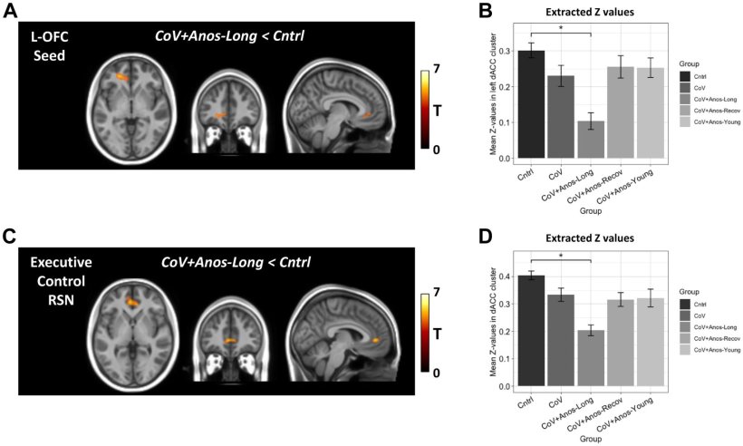Long COVID: correlation between smell loss and changes in the brain