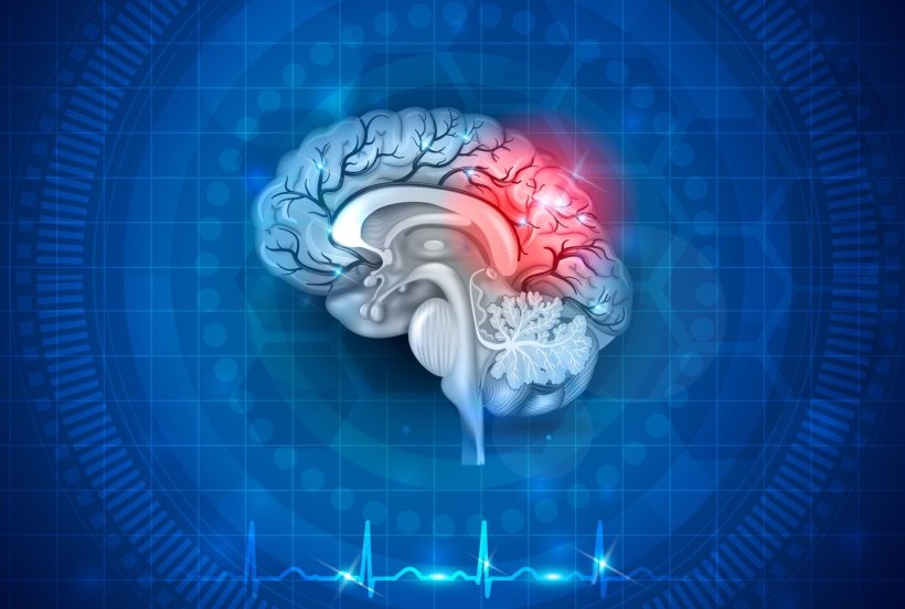 Improvement of stroke diagnosis and treatment through specific genes