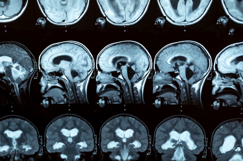 Gene therapy could relieve post-hemorrhagic hydrocephalus