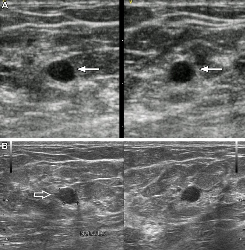 Images in a 37-year-old woman show a palpable mass due to low-grade ductal...
