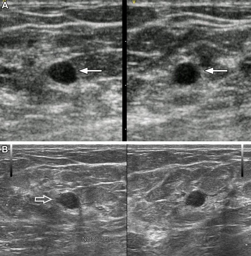 A 60-year-old patient presented by a lump in the left breast