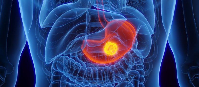 3D illustration of stomach cancer