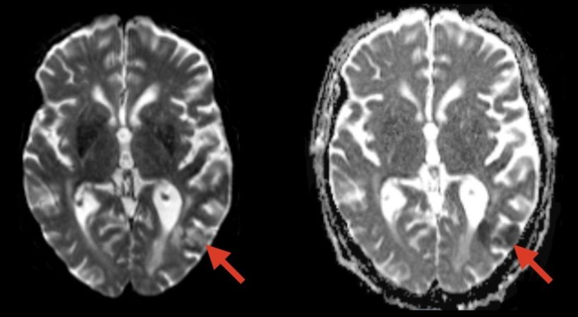 Evidence of a stroke (red arrows) is seen on this MRI scan of a brain of a...