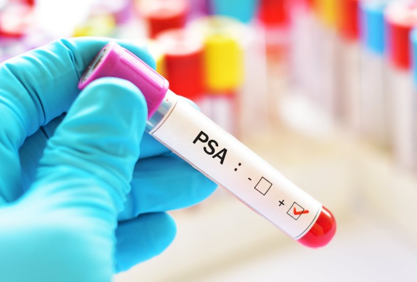 laboratory test tube labelled PSA