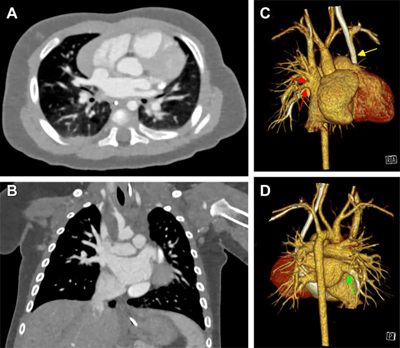 Cardiac photon-counting CT (PCCT) in a 174-day-old male infant with complex...
