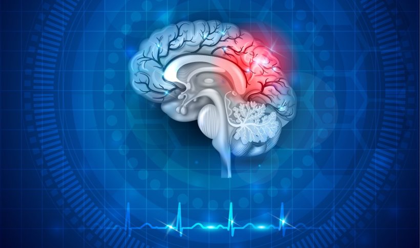 human brain damage from stroke