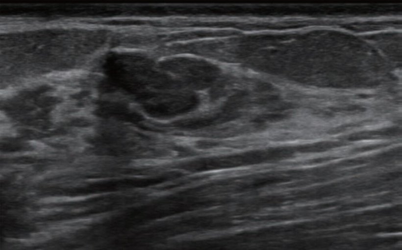 Long-axis gray-scale ultrasound image shows hypoechoic lesion. Lesion was...