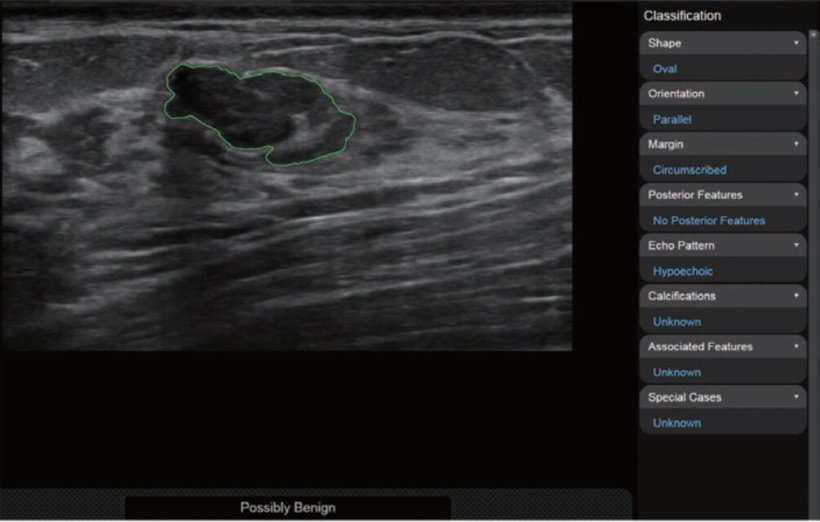 Long-axis greyscale ultrasound image shows results of CAD analysis. CAD...