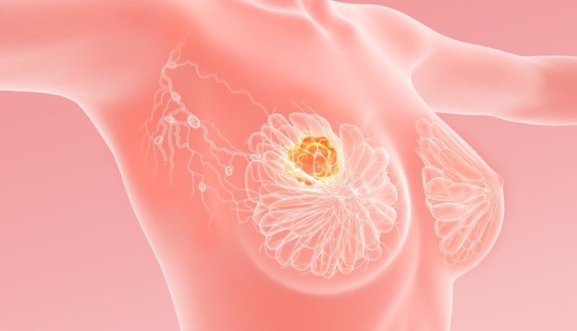 Brustkrebs: Forscher entschlüsseln Mechanismen hinter aggressiven Metastasen