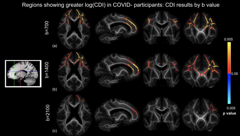 Vergleich des Correlated Diffusion Imaging (CDI) von Covid-positiven und...